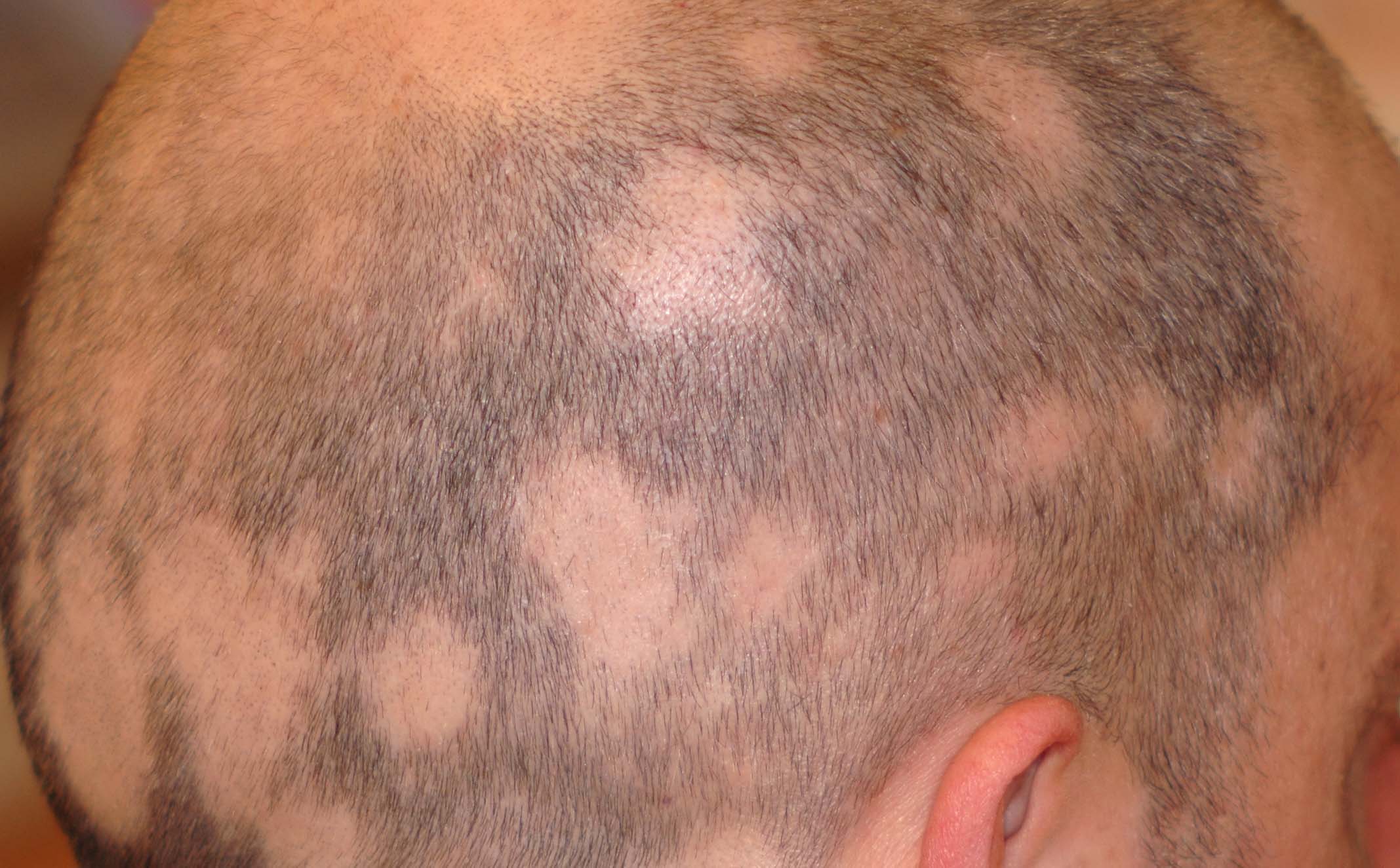 Alopecia areata