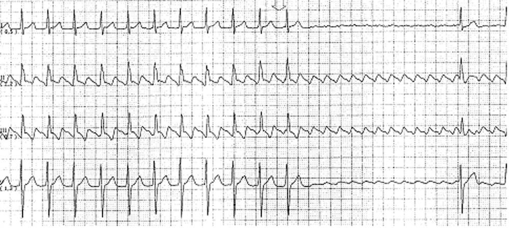 EKG av Förmaksfladder