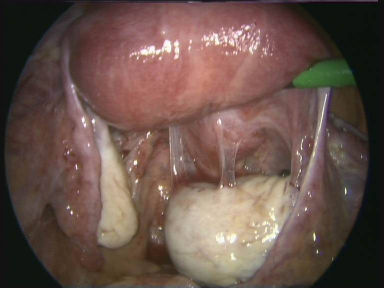 Endometrios (adherenser mellan höger ovarie)