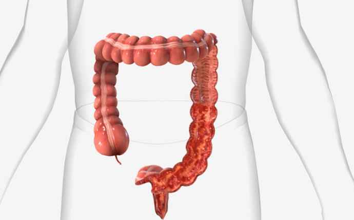 Ulcerative colitis - Ulcerös kolit – kronisk inflammation tarmsjukdom