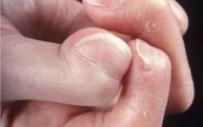Bild av akroosteolys i fingrar (systemisk skleros/sklerodermi)