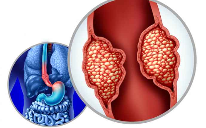 Är risken för att utveckla esofagealt adenocarcinom ökad efter H. pylori-eradikering?