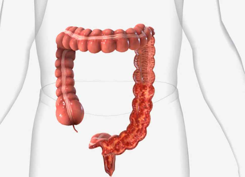 Ulcerative colitis - Ulcerös kolit – kronisk inflammation tarmsjukdom