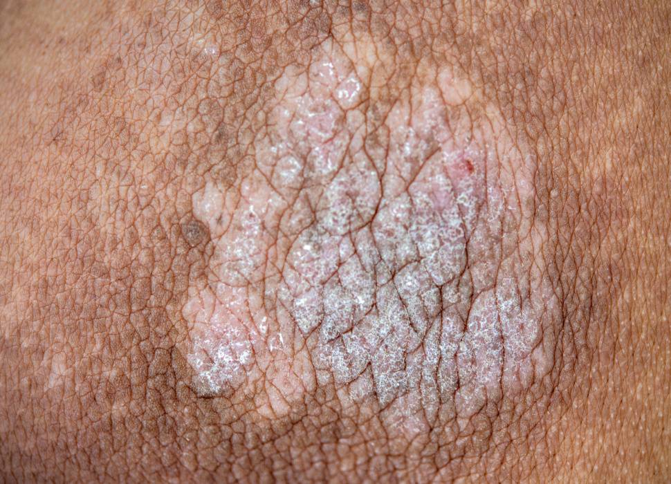 Psoriasis Netdoktorpro Se