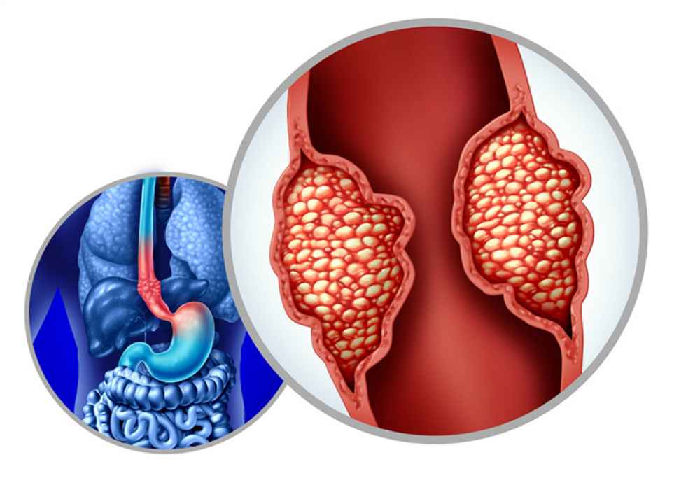 Är risken för att utveckla esofagealt adenocarcinom ökad efter H. pylori-eradikering?