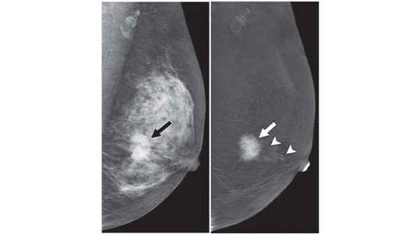 mammografi vs kontrastmammografi