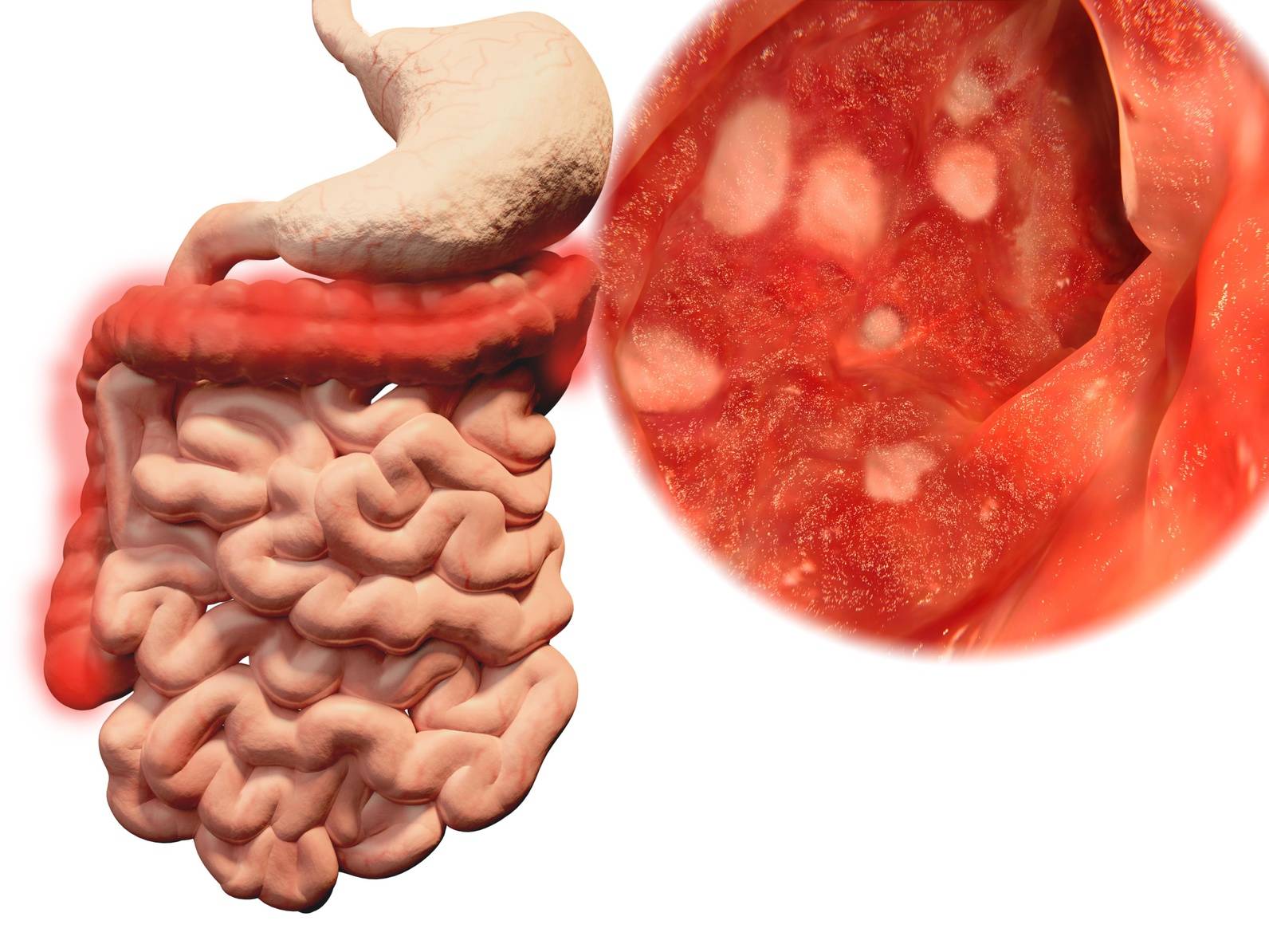 Ulcerös kolit, bild på inflammation i slemhinna - NetdoktorPro.se